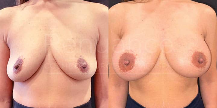 Renuance - breast augmentation by Jose Rodriguez, MD