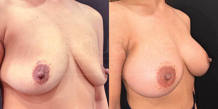 Renuance - breast augmentation by Jose Rodriguez, MD