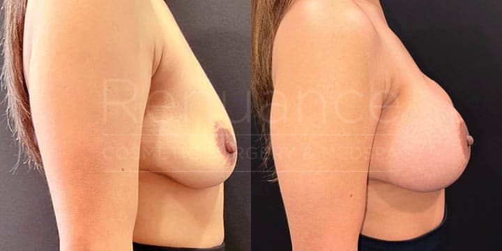 Renuance - breast augmentation by Jose Rodriguez, MD