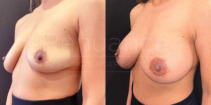 Renuance - breast augmentation by Jose Rodriguez, MD