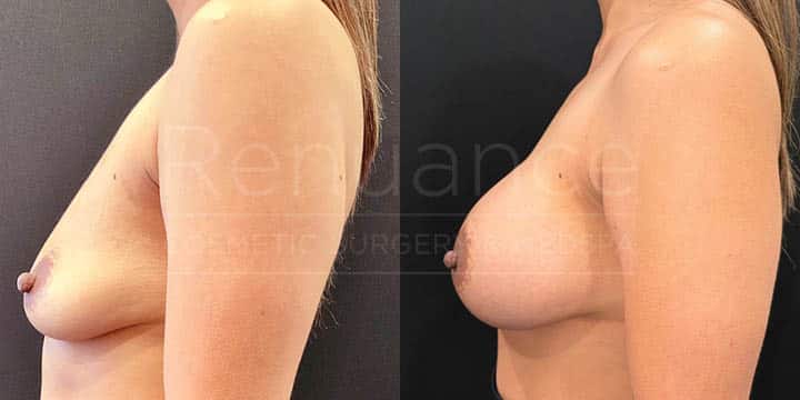 Renuance - breast augmentation by Jose Rodriguez, MD