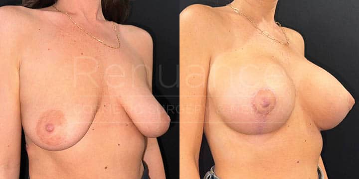 Renuance - breast lift with implants by Jose Rodriguez, MD
