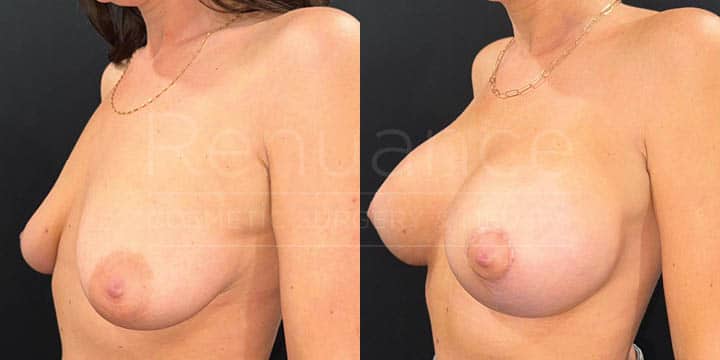 Renuance - breast lift with implants by Jose Rodriguez, MD