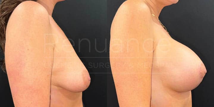 Renuance - breast lift with implants by Jose Rodriguez, MD