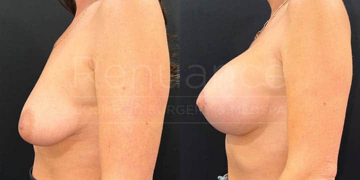 Renuance - breast lift with implants by Jose Rodriguez, MD