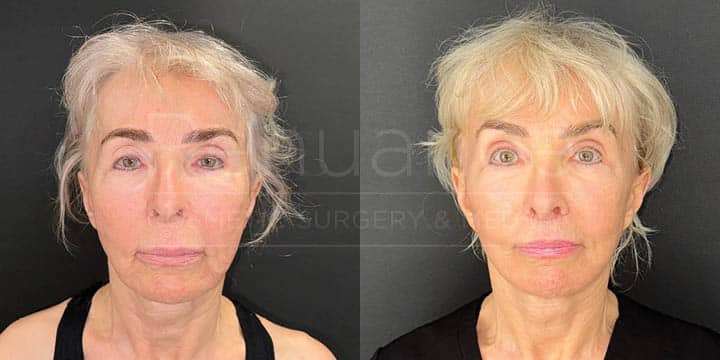 Renuance - face lift, facial fat transfer, and neck lift by Jose Rodriguez, MD