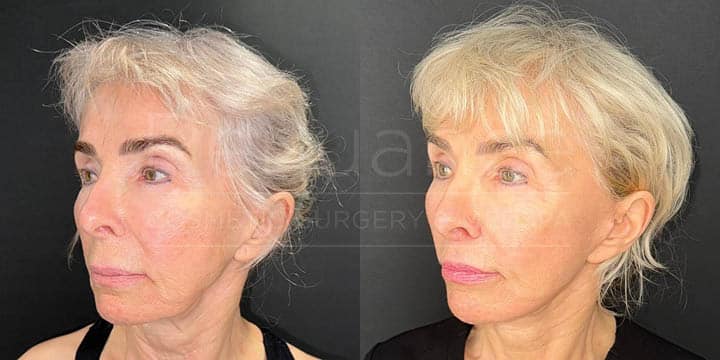 Renuance - face lift, facial fat transfer, and neck lift by Jose Rodriguez, MD