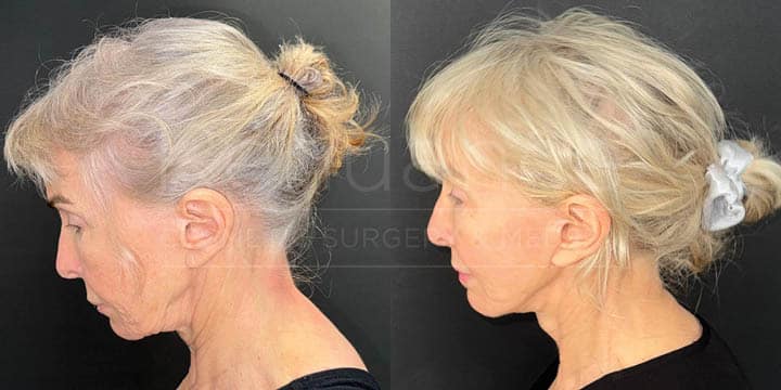 Renuance - face lift, facial fat transfer, and neck lift by Jose Rodriguez, MD