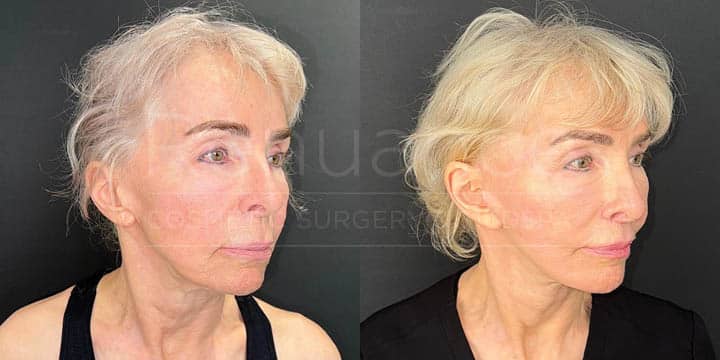 Renuance - face lift, facial fat transfer, and neck lift by Jose Rodriguez, MD