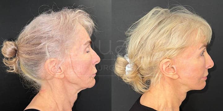 Renuance - face lift, facial fat transfer, and neck lift by Jose Rodriguez, MD