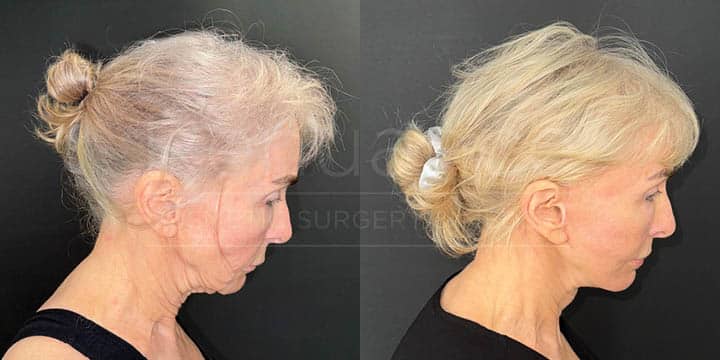 Renuance - face lift, facial fat transfer, and neck lift by Jose Rodriguez, MD