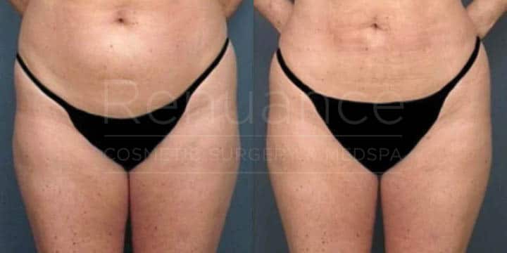 Renuance - body contouring and liposuction by Jose Rodriguez, MD