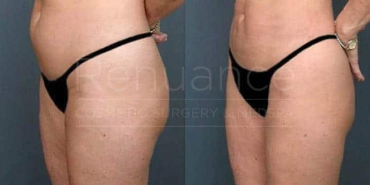 Renuance - body contouring and liposuction by Jose Rodriguez, MD