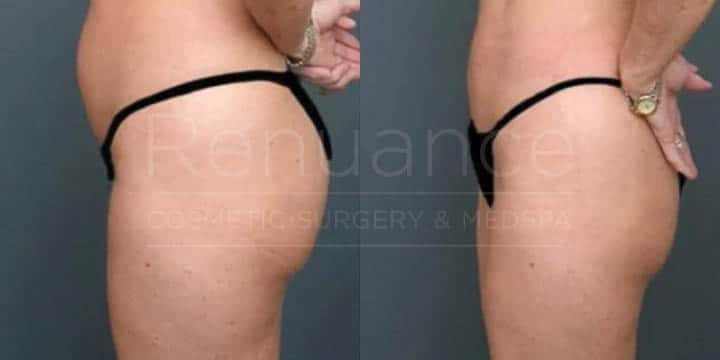 Renuance - body contouring and liposuction by Jose Rodriguez, MD