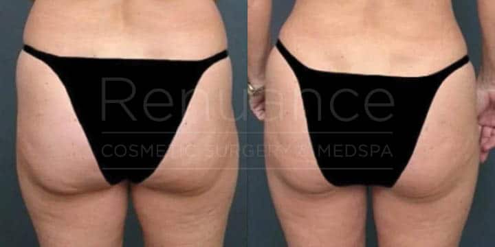 Renuance - body contouring and liposuction by Jose Rodriguez, MD