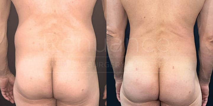 Renuance - body contouring, liposuction, and bbl by Jose Rodriguez, MD