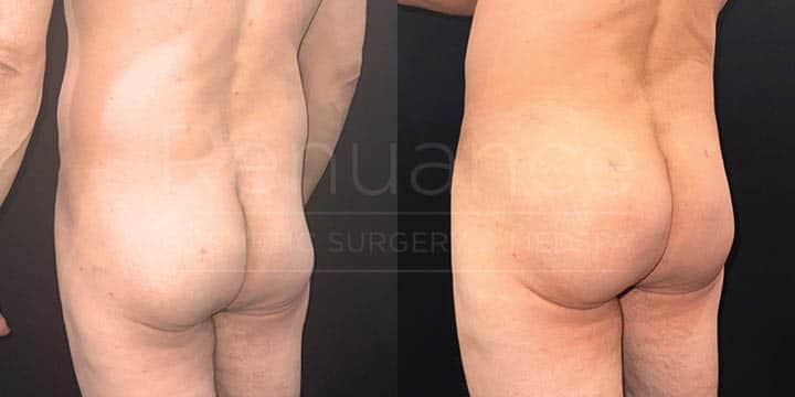 Renuance - body contouring, liposuction, and bbl by Jose Rodriguez, MD