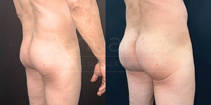 Renuance - body contouring, liposuction, and bbl by Jose Rodriguez, MD