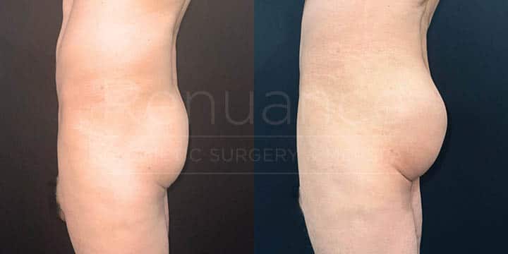 Renuance - body contouring, liposuction, and bbl by Jose Rodriguez, MD