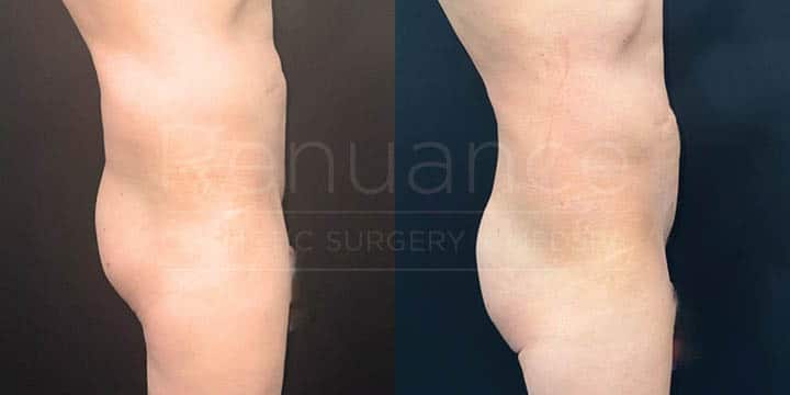 Renuance - body contouring, liposuction, and bbl by Jose Rodriguez, MD