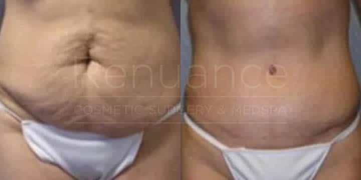 Renuance - tummy tuck by Jose Rodriguez, MD