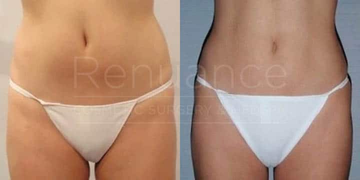 Renuance - body contouring and liposuction by Jose Rodriguez, MD