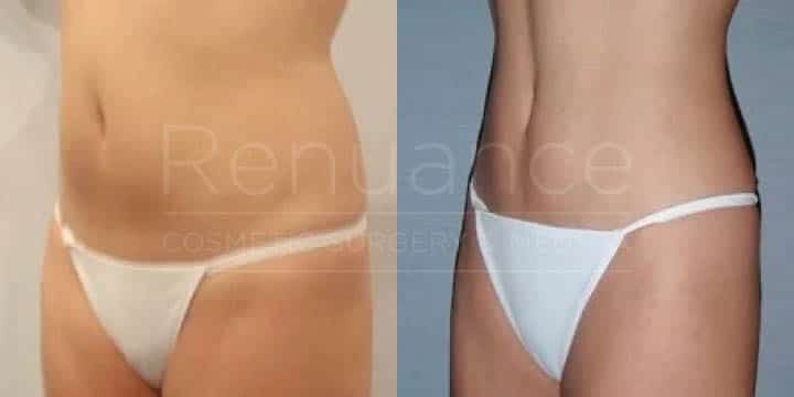 Renuance - body contouring and liposuction by Jose Rodriguez, MD