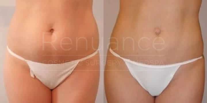 Renuance - body contouring and liposuction by Jose Rodriguez, MD
