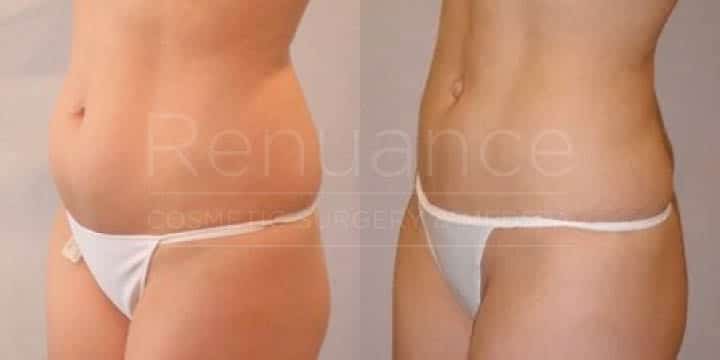 Renuance - body contouring and liposuction by Jose Rodriguez, MD