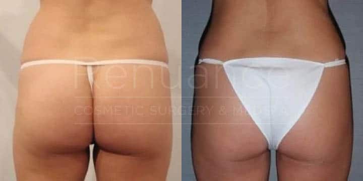 Renuance - body contouring and liposuction by Jose Rodriguez, MD