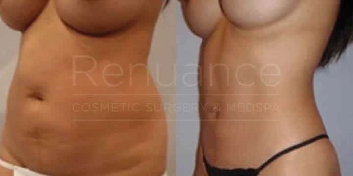 Renuance - body contouring and liposuction by Jose Rodriguez, MD
