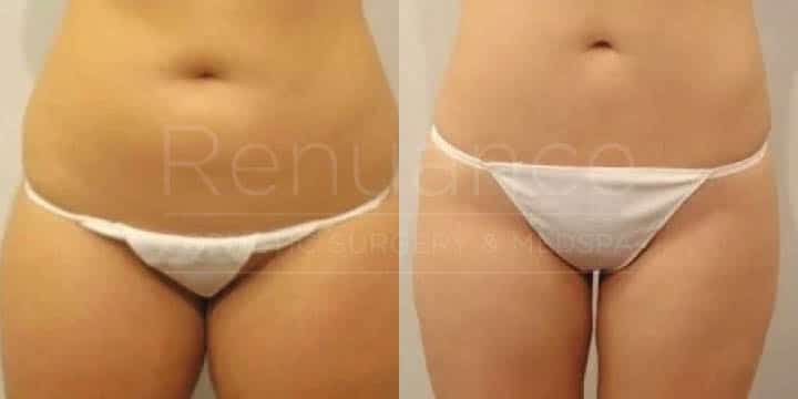 Renuance - body contouring and liposuction by Jose Rodriguez, MD
