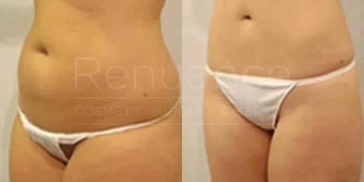 Renuance - body contouring and liposuction by Jose Rodriguez, MD