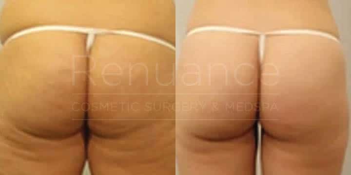 Renuance - body contouring and liposuction by Jose Rodriguez, MD