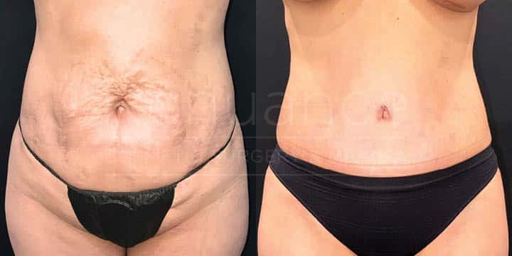 Renuance - tummy tuck by Jose Rodriguez, MD