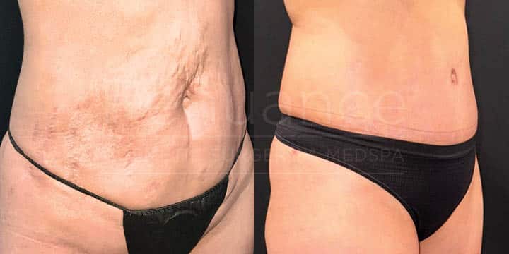 Renuance - tummy tuck by Jose Rodriguez, MD