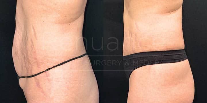 Renuance - tummy tuck by Jose Rodriguez, MD