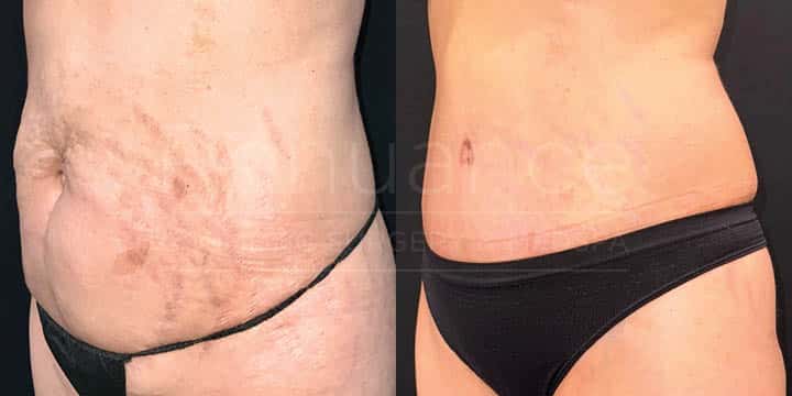 Renuance - tummy tuck by Jose Rodriguez, MD