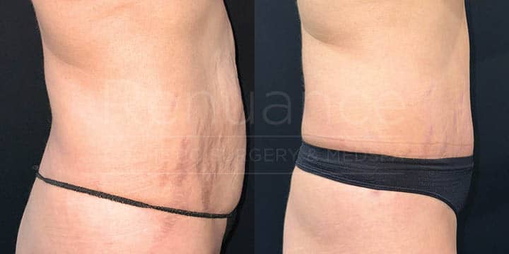 Renuance - tummy tuck by Jose Rodriguez, MD
