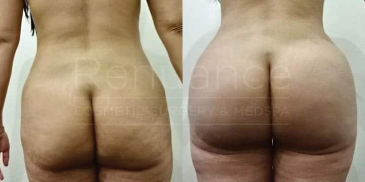 Renuance - body contouring, liposuction, and bbl by Jose Rodriguez, MD