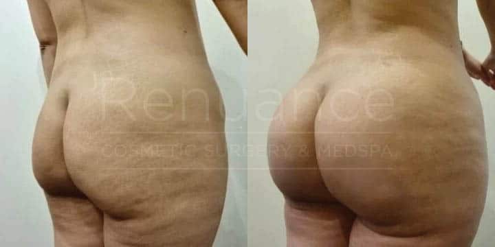 Renuance - body contouring, liposuction, and bbl by Jose Rodriguez, MD