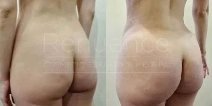 Renuance - body contouring, liposuction, and bbl by Jose Rodriguez, MD