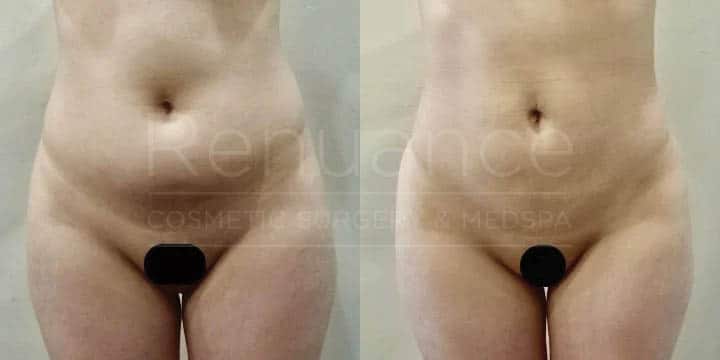 Renuance - body contouring, liposuction, and bbl by Jose Rodriguez, MD