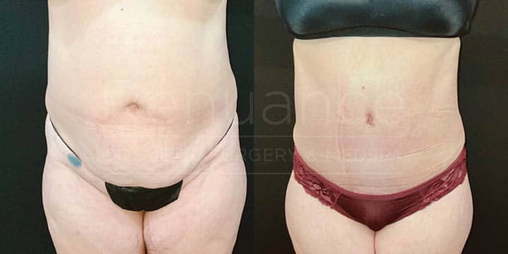 Renuance - tummy tuck by Jose Rodriguez, MD