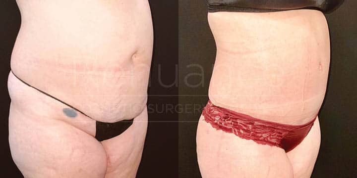 Renuance - tummy tuck by Jose Rodriguez, MD