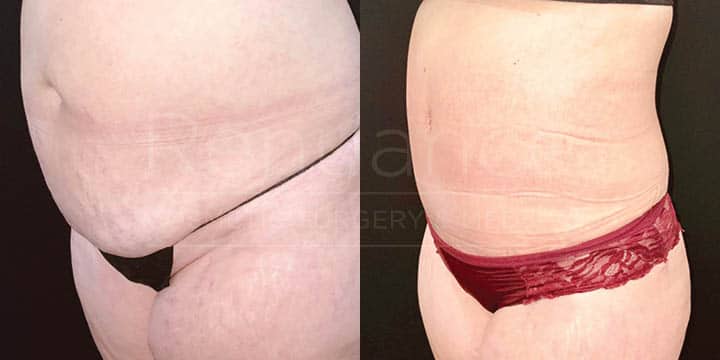 Renuance - tummy tuck by Jose Rodriguez, MD