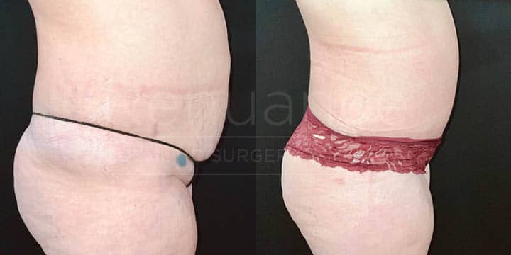Renuance - tummy tuck by Jose Rodriguez, MD