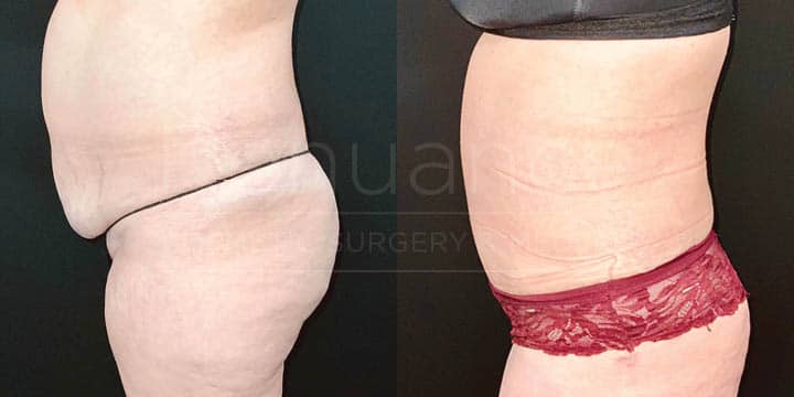 Renuance - tummy tuck by Jose Rodriguez, MD