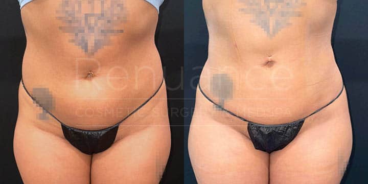 Renuance - renuvion skin tightening and liposuction by Jose Rodriguez, MD