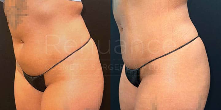 Renuance - renuvion skin tightening and liposuction by Jose Rodriguez, MD